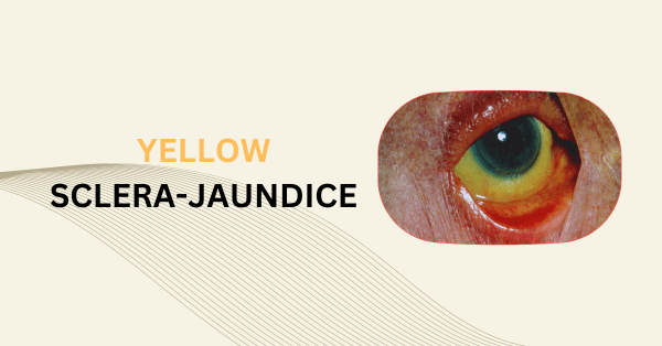 JAUNDICE – Definition, Mechanism, Types, Causes & Treatment