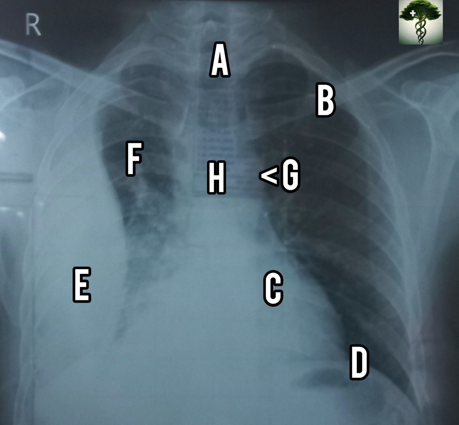 Quick tips to Interpret X ray chest PA view - HealthBanyan