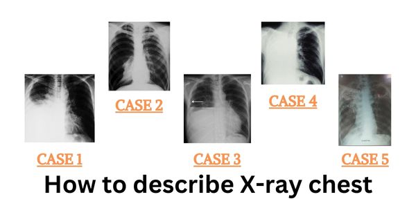 How to describe X-ray chest