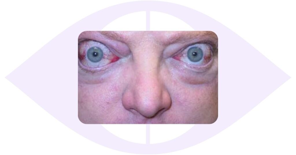 thyroid ophthalmopathy