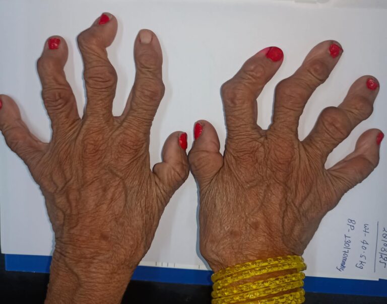 Deformed hands by RA(Rheumatoid Arthritis)