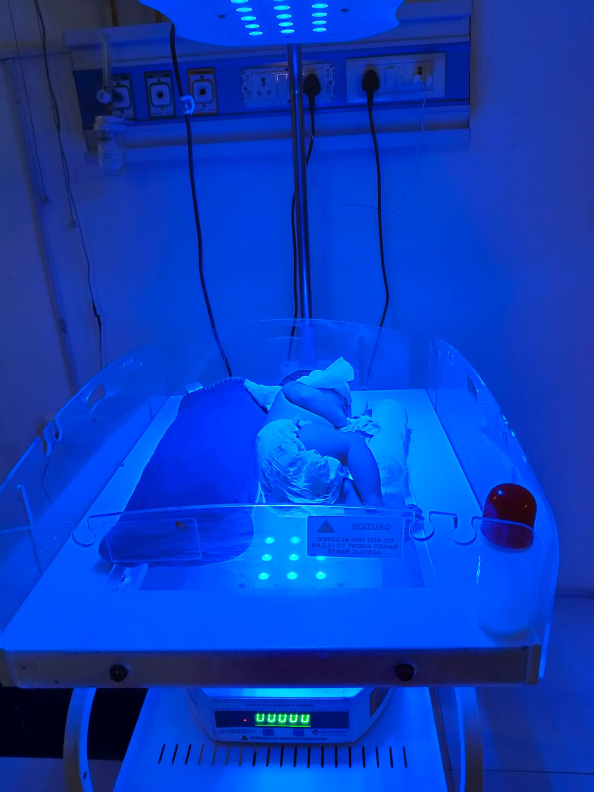 Phototherepy dr nirmala singh child Specilaist Nicu kanpur ashok nagar